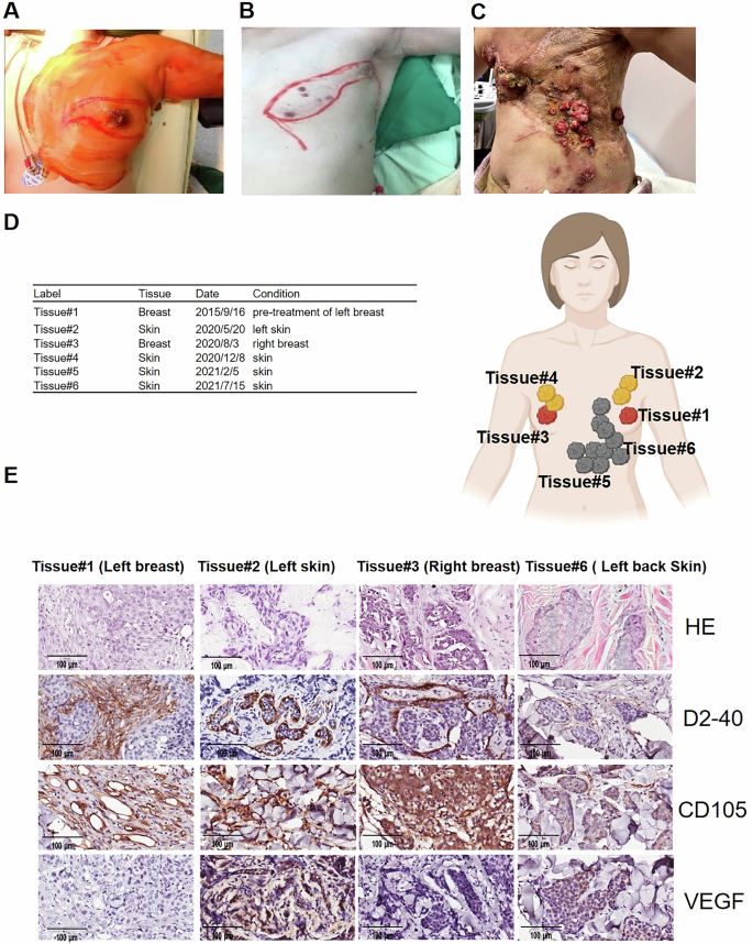 Fig. 2: CM is associated with increased angiogenic activity in primary tumors and metastatic skin lesions.