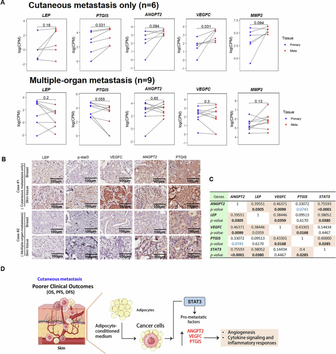 Fig. 7: Elevated expression of pro-metastatic genes in cutaneous metastases compared to primary breast tumors.