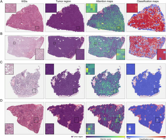 Fig. 4: Visualization of attention and patch-level classification scores for LNM prediction using the UNI_CTMIL model.