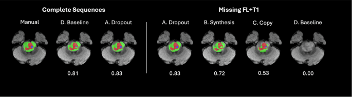 Fig. 3: Representative Segmentation Results with Complete and Incomplete MRI Input.