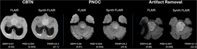 Fig. 5: Representative Synthesis Examples from CBTN/BraTS-PEDs and PNOC.