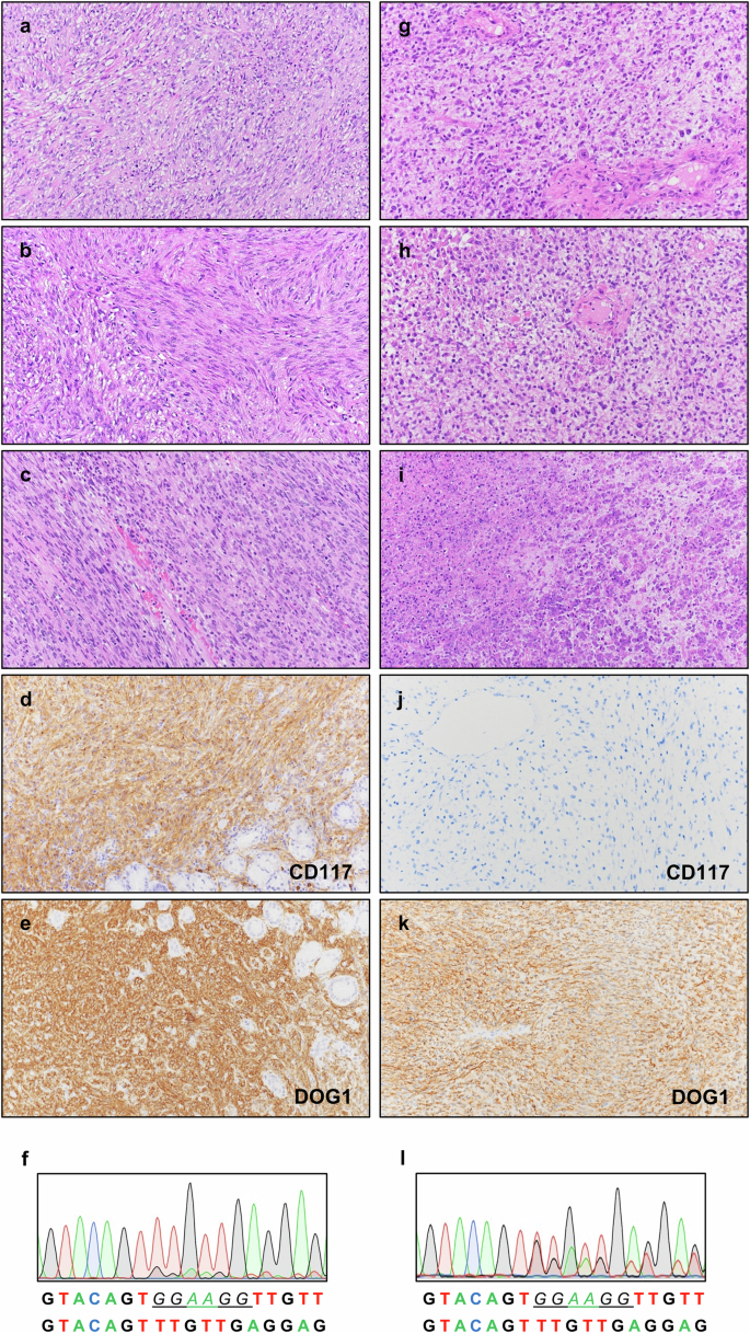 Fig. 1: Morphological and immunophenotypic features and KIT mutation status of the primary GIST (left) and the corresponding relapse (right).