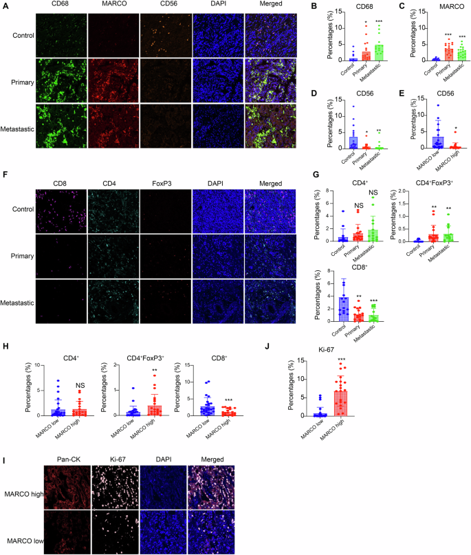 Fig. 5: Increased MARCO-expressing macrophages and decreased cytotoxicity of T/NK cells in pancreatic cancer tissue and metastatic tissue.