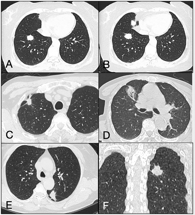 Fig. 4: Schematic illustration of pleura-associated nodules on CT.