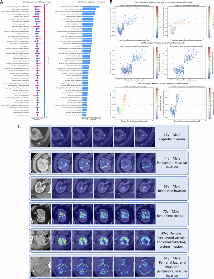 Fig. 3: Interpretability analysis of radiomics and deep learning models.