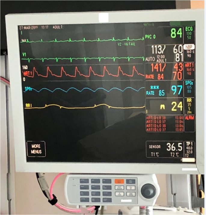An algorithm strategy for precise patient monitoring in a connected  healthcare enterprise | npj Digital Medicine