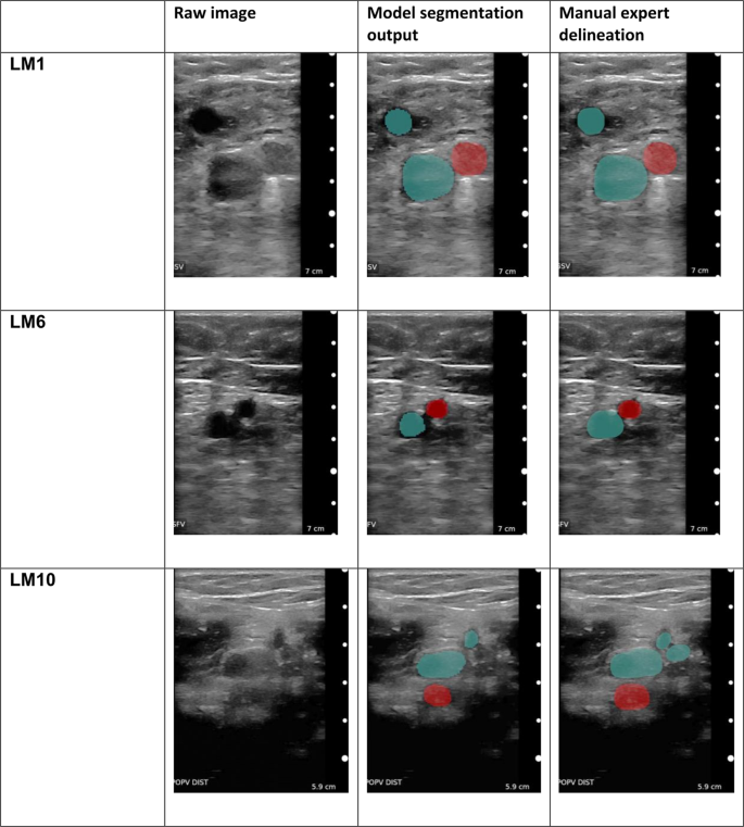 blood clot in leg ultrasound