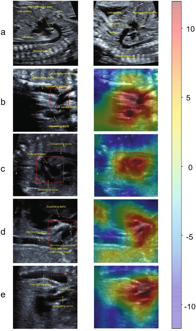 Fig. 3: Example of images of duct-dependent CHDs and normal fetal hearts and corresponding heatmaps from DDCHD-DenseNet.