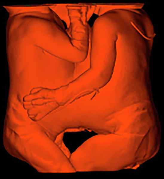Fig. 2: 3D static twins for conjoined twin separation.