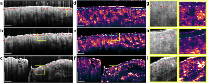 Fig. 2: Comparison of OCT and OAC Images, highlighting the finer structural details revealed in OAC.