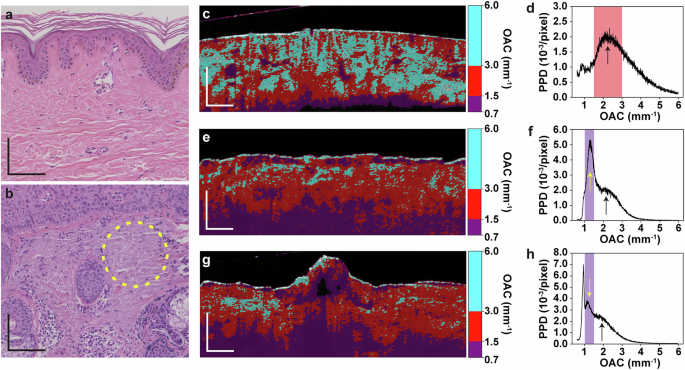 Fig. 3: Comparison of AK and normal skin on pathology, OAC images, and PDF.
