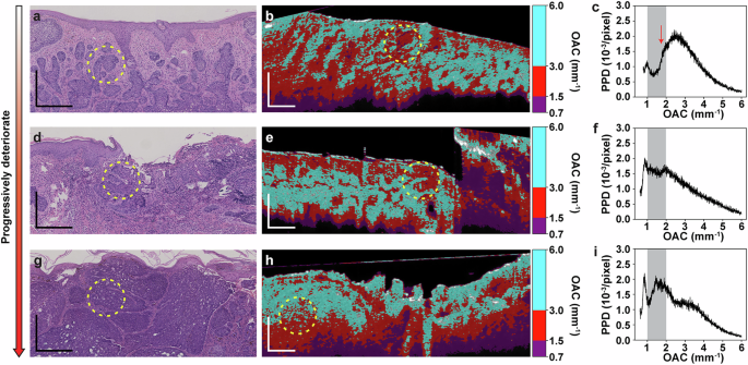 Fig. 4: Comparative analysis of pathological images, OAC images, and PDF of BCC across varying severity levels.