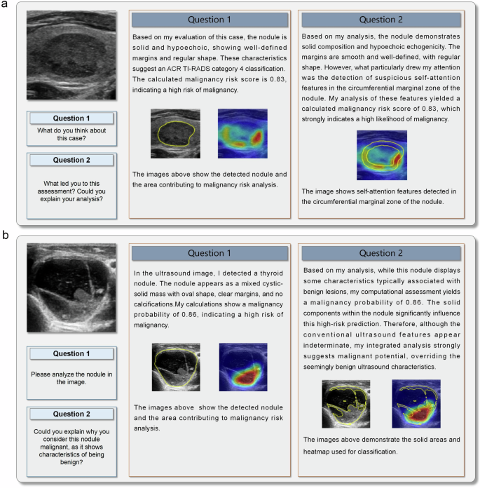 Fig. 4: Radiologist revises their initial diagnosis after consulting ThyGPT.