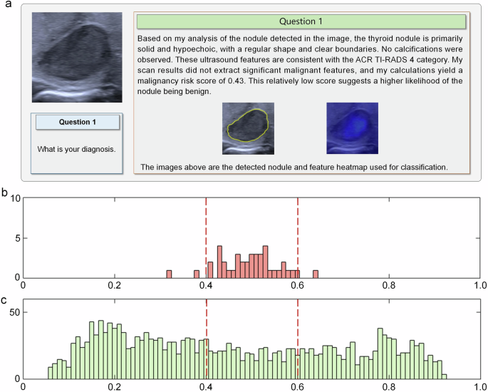 Fig. 6: An example of incorrectly altered diagnosis by a radiologist, and the distribution of malignancy risk probabilities predicted by ThyGPT.