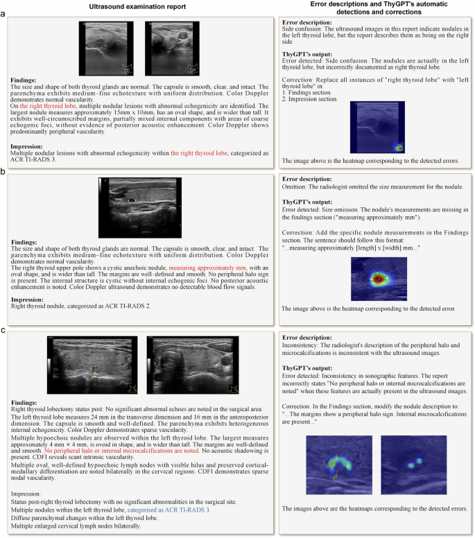 Fig. 7: ThyGPT facilitates the detection of errors in US diagnostic reports.