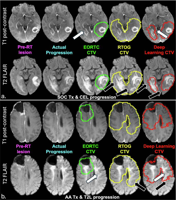Fig. 4: Comparison of CTVs for 2 example patients in the test set.