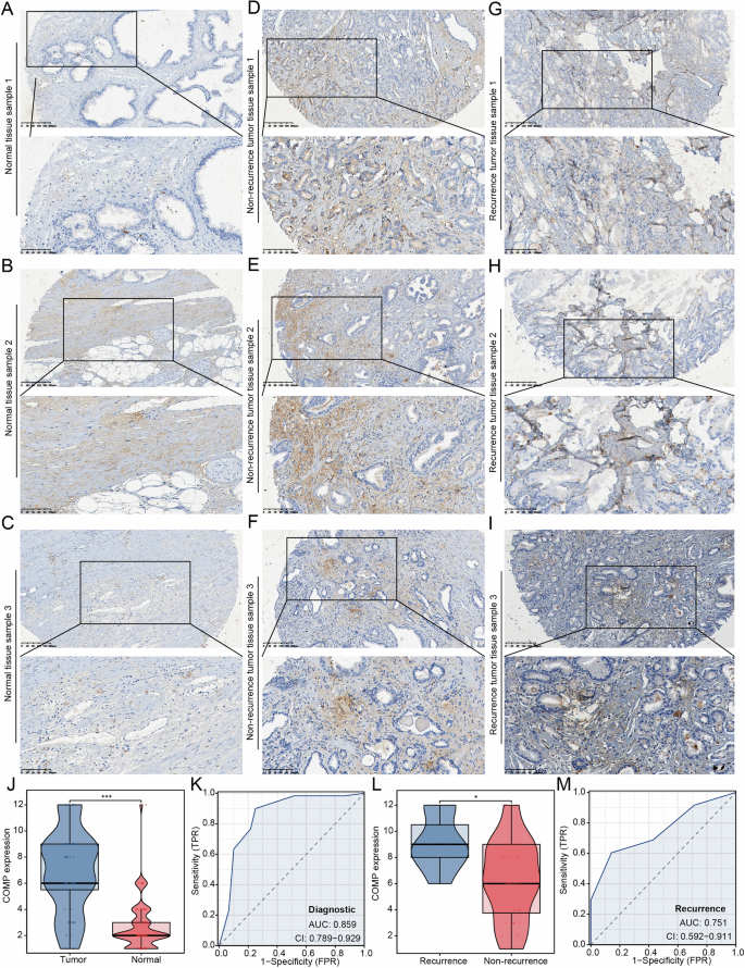 Fig. 8: COMP is highly expressed in PRAD.