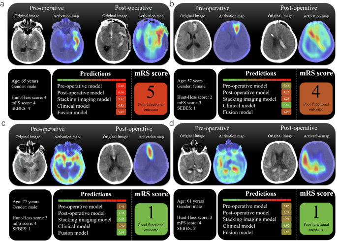 Fig. 5: Examples of five models predicting different functional outcomes and their corresponding activation maps of pre- and postoperative NCCT images.