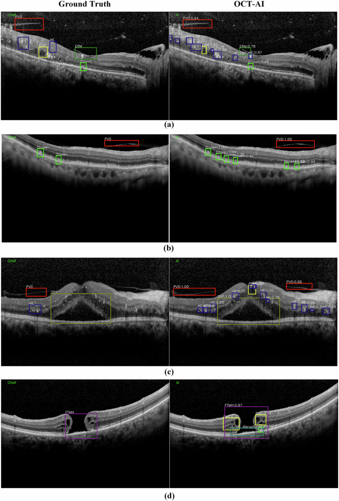 Fig. 1: Four example results of retinal anomalies detection.