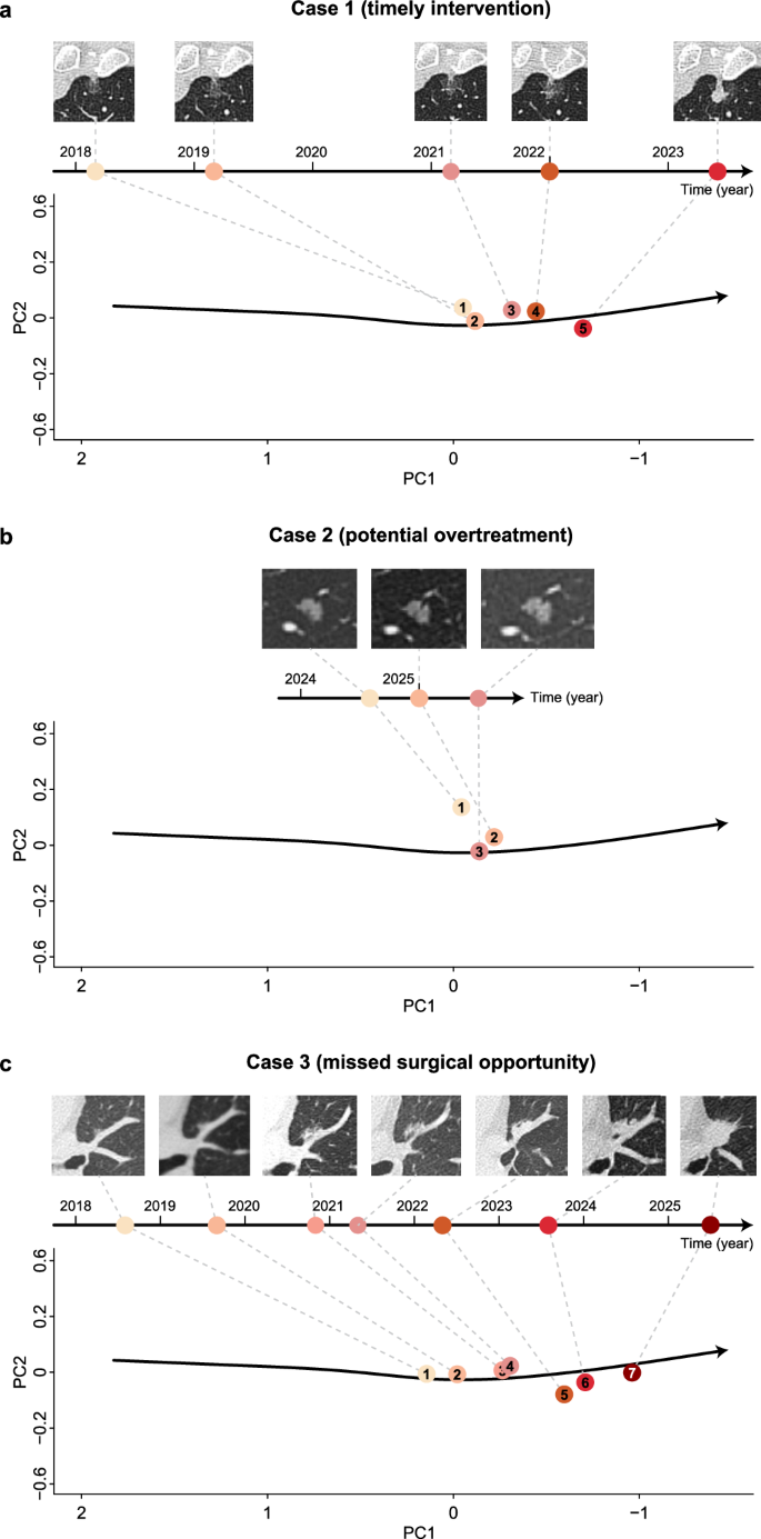 Fig. 5: Longitudinal changes of individual tumors from three patients along with the RadioTrace.