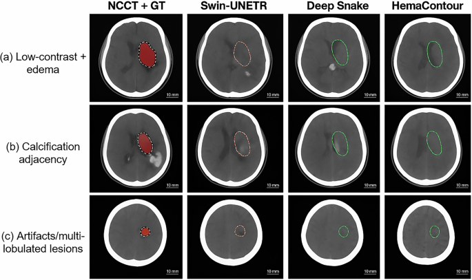 Fig. 7: Qualitative lesion visualization on NCCT (4 columns × 3 rows).