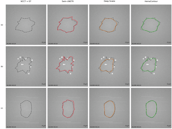 Fig. 8: Qualitative lesion visualization on NCCT (4 columns × 3 rows).