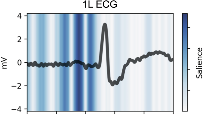 Fig. 5: 1 L ECG-AI Saliency map.