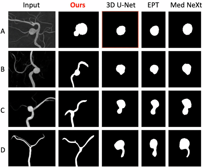 Fig. 4: Case-wise aneurysm segmentation comparison.