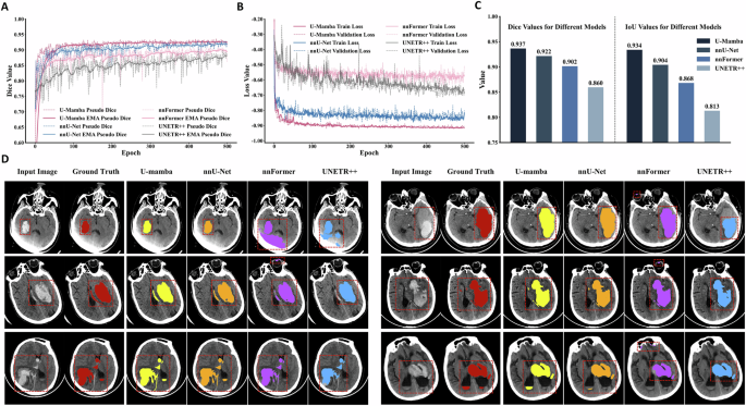 Fig. 3: Benchmarking of four 3D hematoma segmentation models.