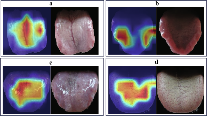 Fig. 3: Visualization of attended regions generated by EigenCAM during tongue diagnosis.