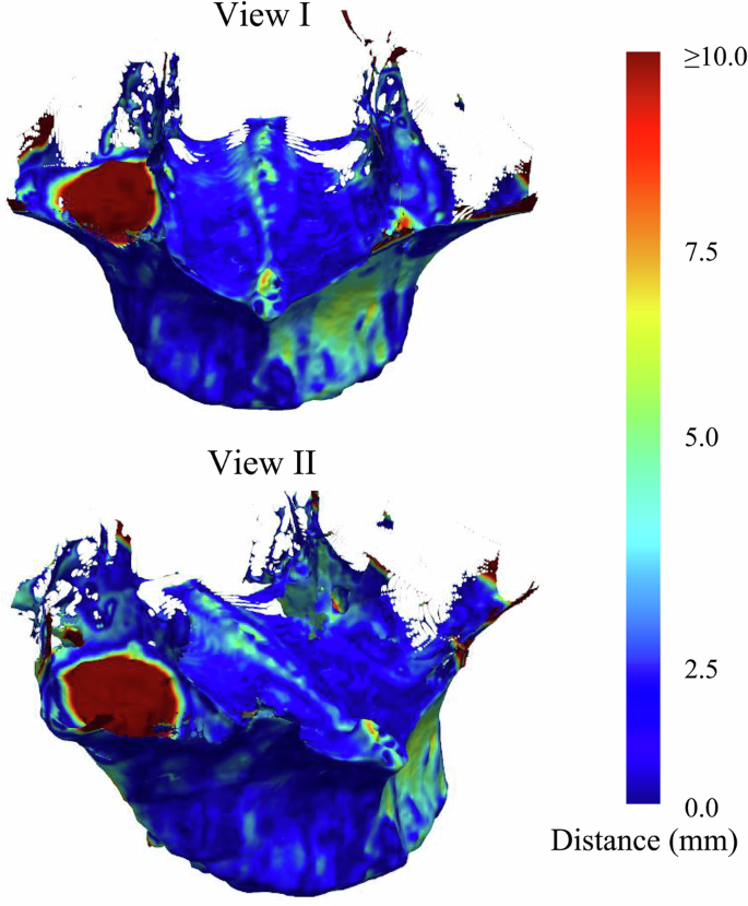 Fig. 3: Heat map of 3D distance error distribution between pre- and post-operative maxillae following registration.
