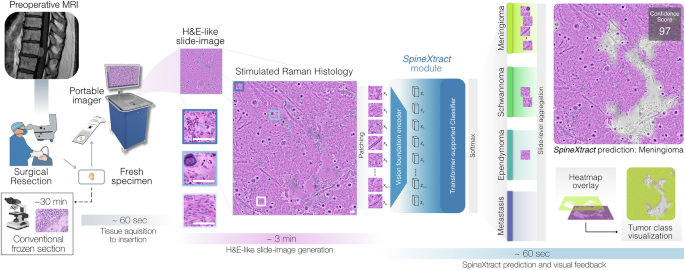 Fig. 1: Clinical workflow of SpineXtract for intraoperative spine tumor diagnosis.