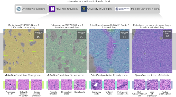 Fig. 3: Interpretable AI-guided diagnosis of spine tumors across international institutions.