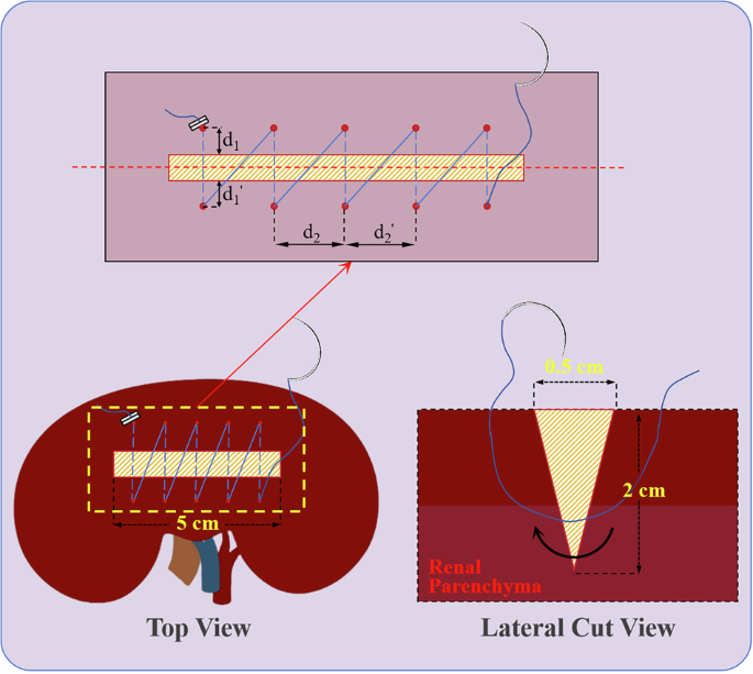 Fig. 17: Schematic illustration of sutured renal incision with key suture quality parameters.