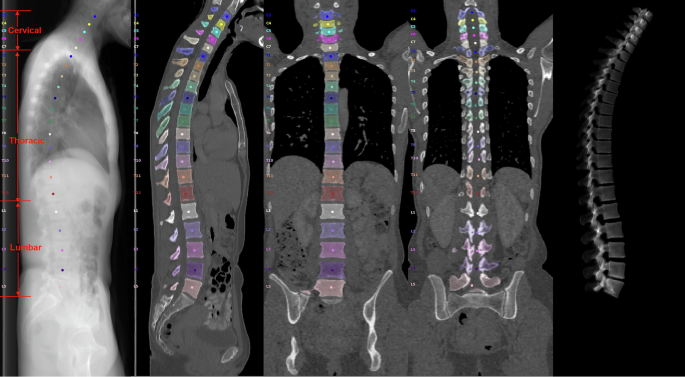 Fig. 5: The use of axial computed tomography (CT) imaging to illustrate how the MultiSpine benchmark isdefined for the Cervical, Thoracic, and Lumbar regions of the spine.