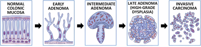 Fig. 2: Schematic of the Adenoma carcinoma sequence.