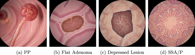 Fig. 3: Examples of Challenging Polyp Morphologies.