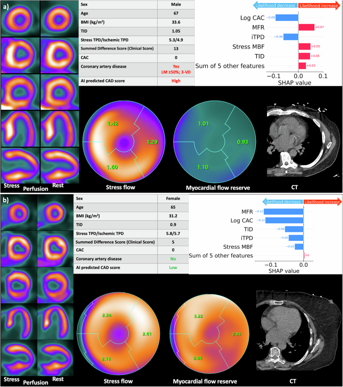 Fig. 3: Examples of PET/CT imaging in predicted CAD patients.