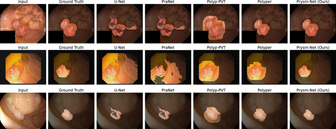 Fig. 1: Qualitative comparisons on challenging cases from Kvasir-SEG (top row), CVC-ClinicDB (middle row), and the cross-domain ETIS dataset (bottom row).