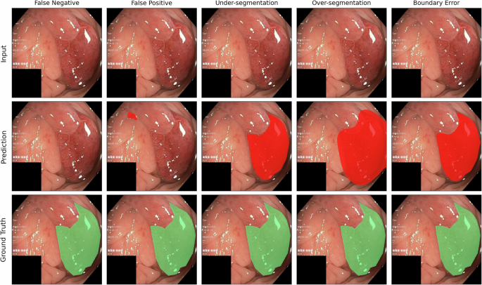 Fig. 3: Failure modes on challenging colonoscopy frames.