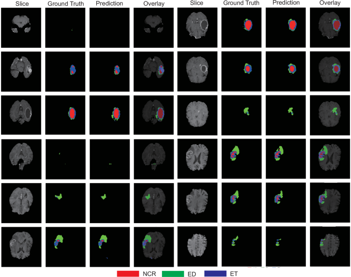 Fig. 1: Representative glioma segmentation results on BraTS21 dataset.