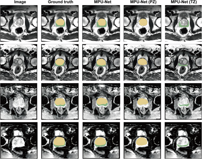 Fig. 2: Comparison of Prostate Zone (PZ/TZ/CZ) Segmentation Results between AI U-Net + + Model and Traditional Manual Segmentation (adapted/redrawn from published work and publicly available data30).