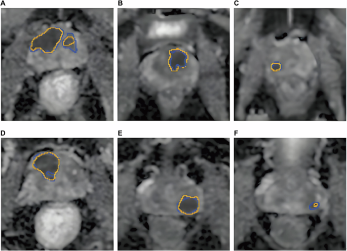 Fig. 3: Comparison of csPCa identification between AI (ViT-MRI model) and senior radiologists.
