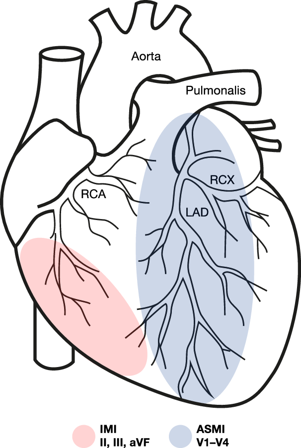 Fig. 1: Clinical association between ECG leads and MI locations.