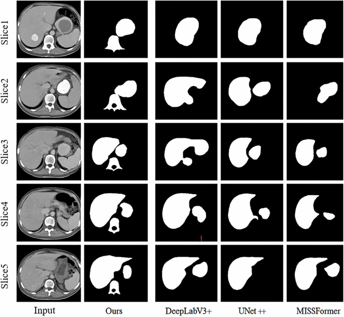 Fig. 2: Qualitative comparison of liver tumor segmentation results on a representative HCC case.