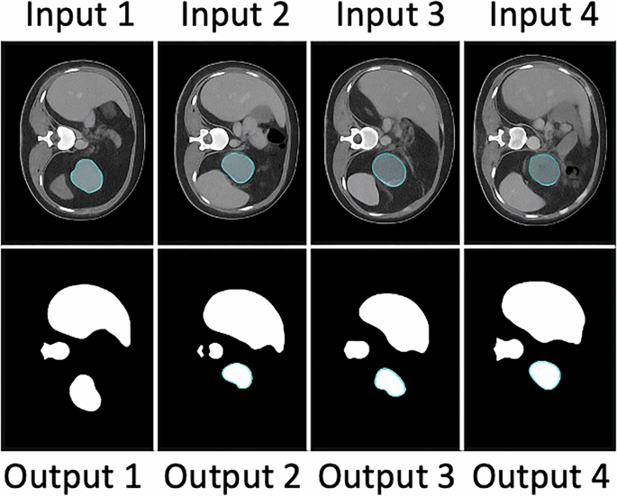 Fig. 3: Qualitative visualization for HCC lesion segmentation.
