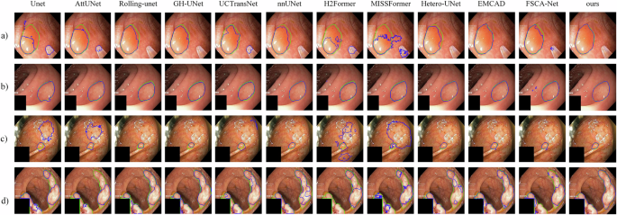 Fig. 2: Qualitative comparison of segmentation results on the Kvasir-SEG dataset.