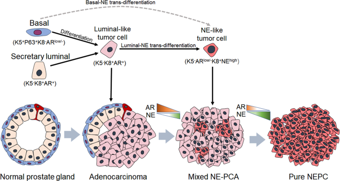 neuroendocrine cancer of prostate papilomi i paraziti u organizmu