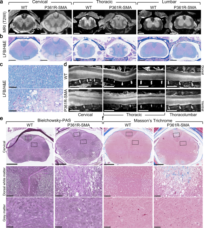 Fig. 4: Ex vivo MRI and histological staining of spinal cords of 21-23-week-old P361R-SMA mice.
