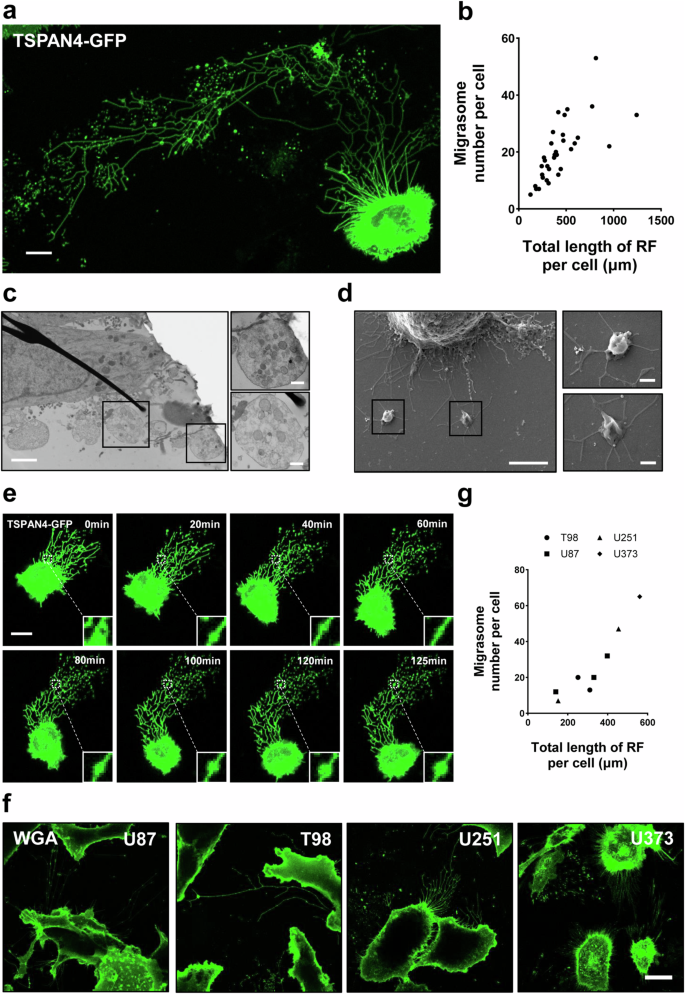 Fig. 1: Detection of migrasomes in glioblastoma (GBM).